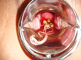 MiracleSatchin Japanese laminaria stick insertion my Cervix  (8)