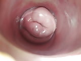 mi cervix (1)